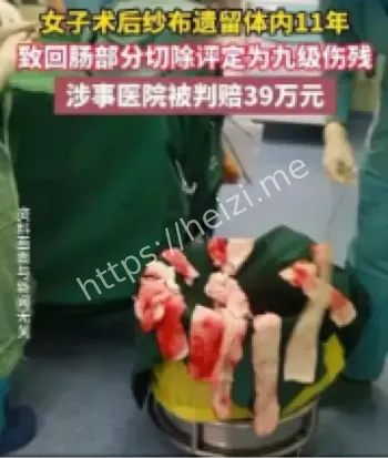 术后纱布遗留医疗事故